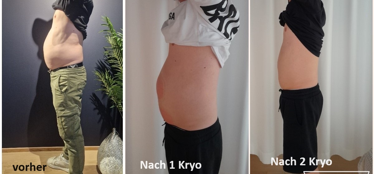 vorher nachher verlauf eines Mannes in der Bauchregion mit Kryolipolyse - vorher, 1 Kryo-Behandlung und nach der zweiten