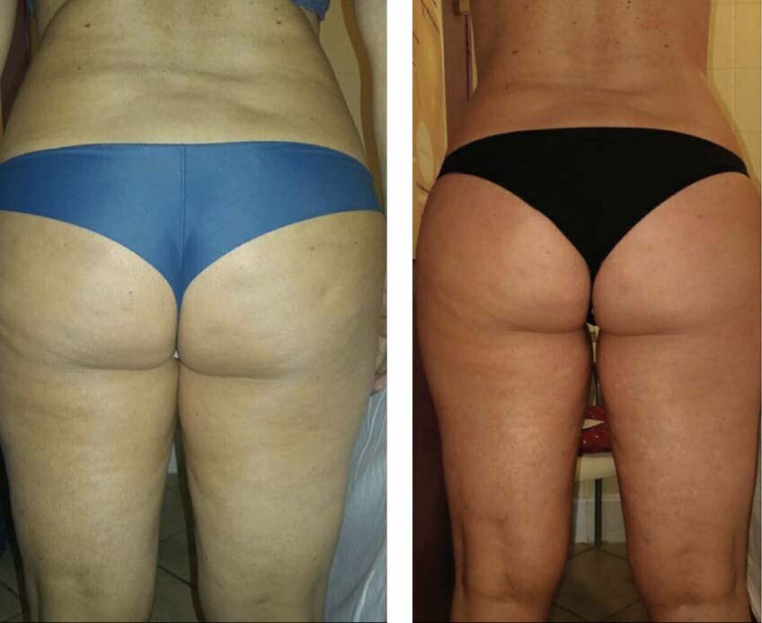 Vorher nachher Bild vom PO und Hüften einer Frau nach einer Kroylipolyse Behandlung bei Bodyforming